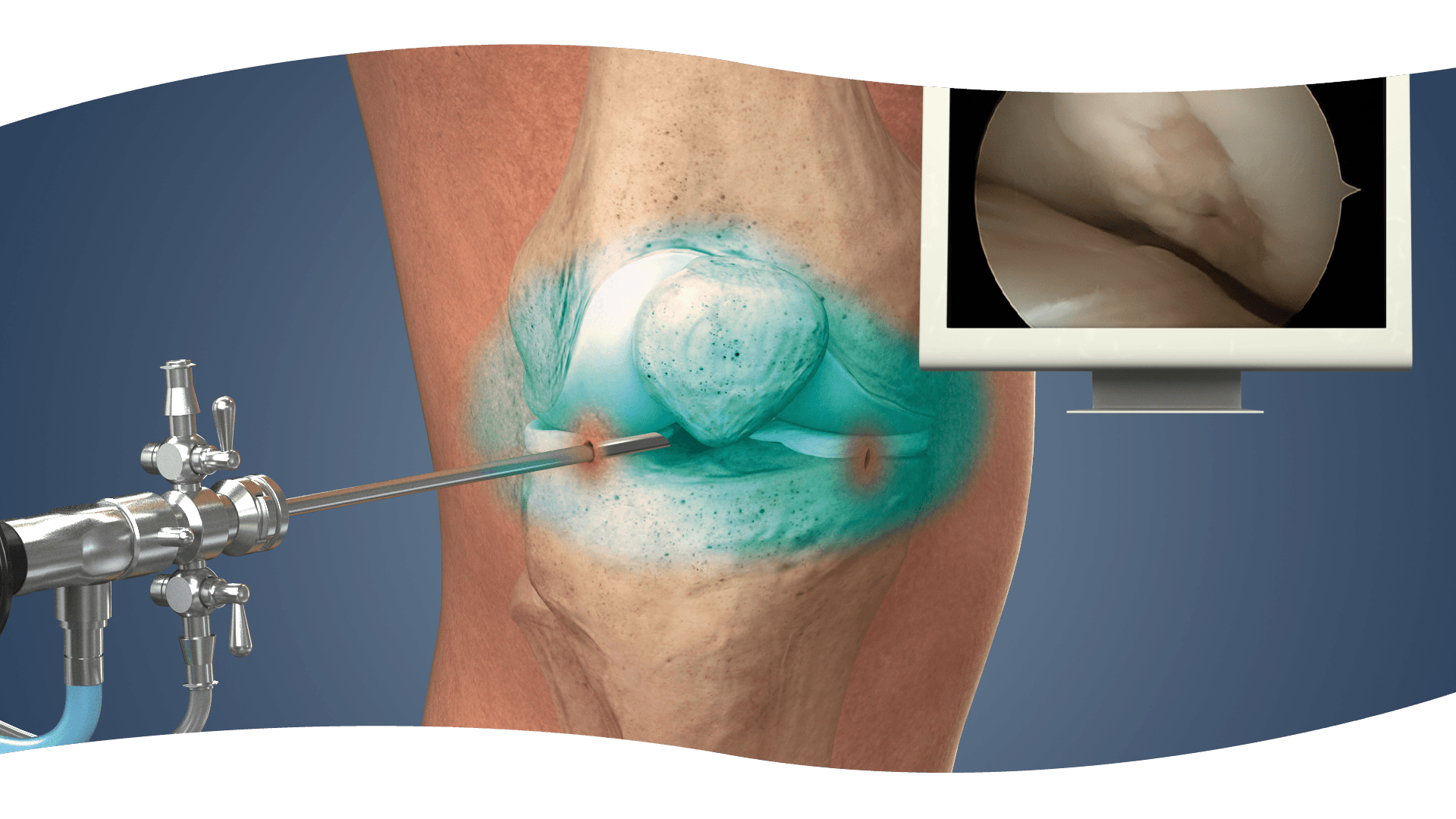 Procedures Ossein
